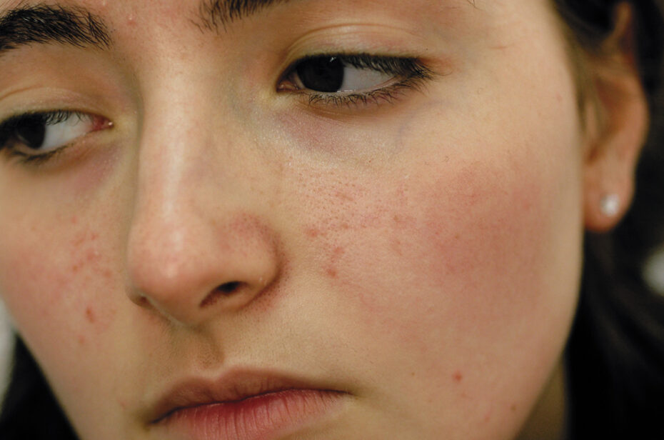 Pimples can be a source of embarrassment